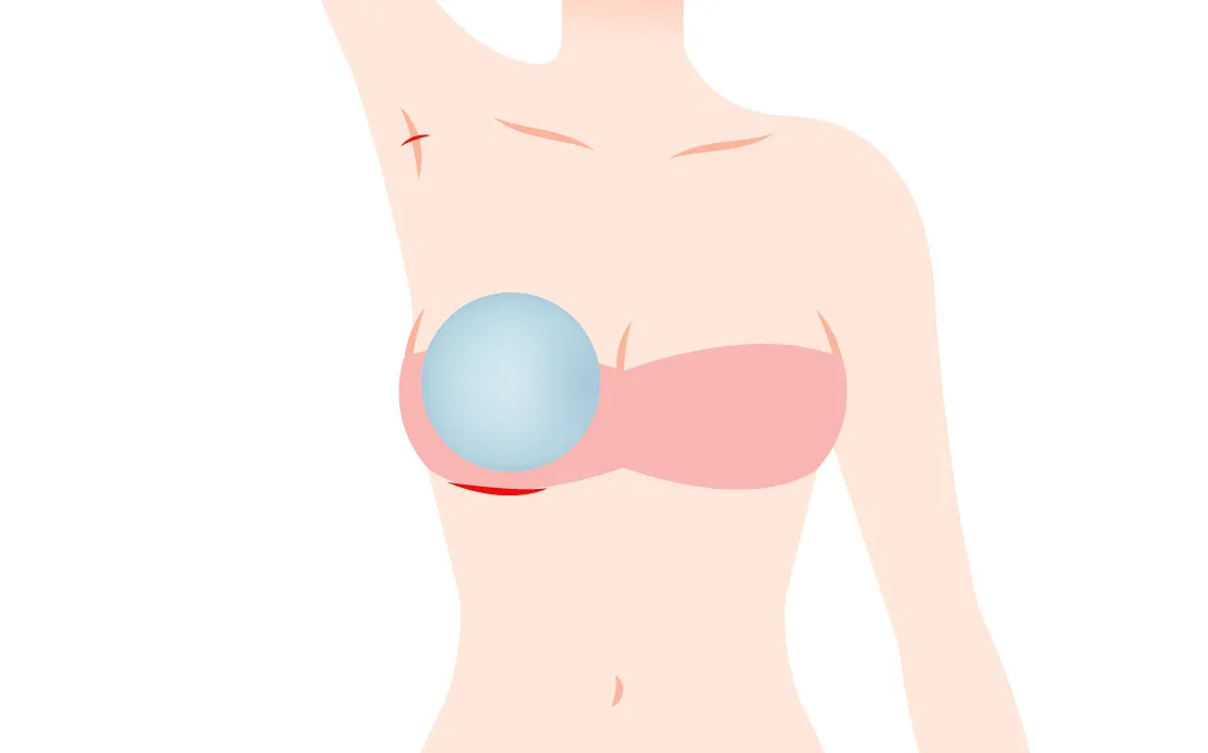 シリコンバッグ豊胸