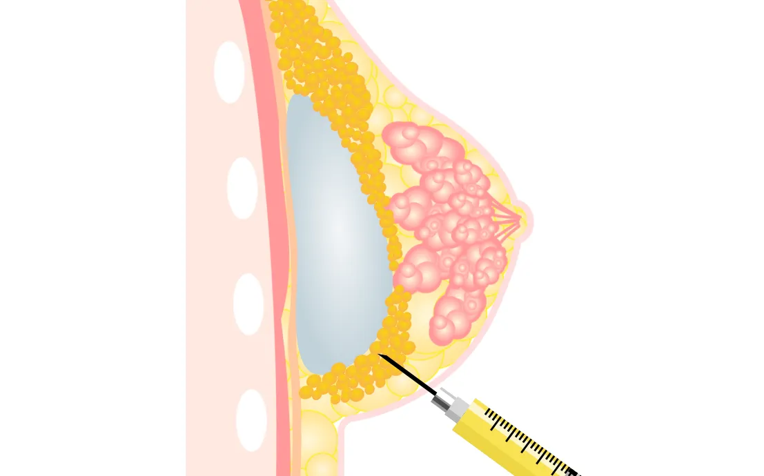 ハイブリッド豊胸