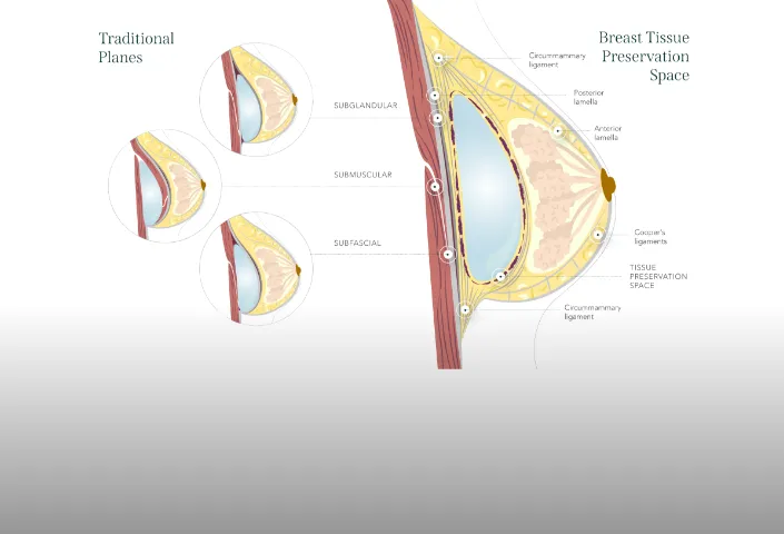 乳房が安定しやすく長期的に美しい