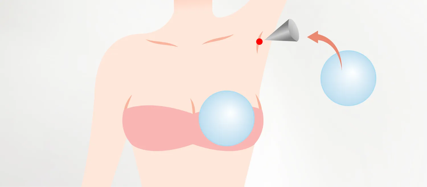 ブレストクリニックの豊胸はケラーファンネルを使用