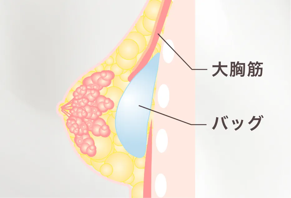 Dual plane法（デュアルプレーン法）